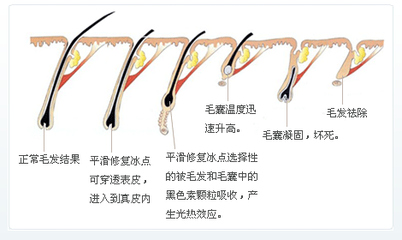 深圳科美丽格冰点脱毛原理