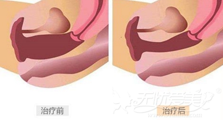 上海伊莱美激光阴道紧缩术治疗效果图