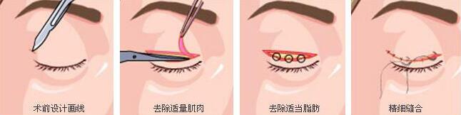重庆联合丽格医院双眼皮整形术
