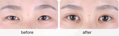 北京首玺丽格医疗美容双眼皮手术