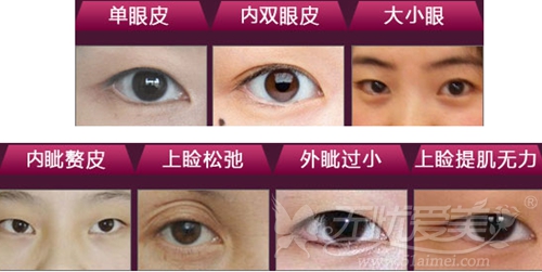石狮柏丽眼部精细化手术可以改善的眼部问题