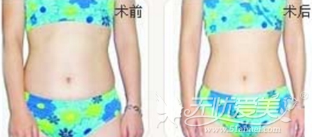 桂林美莱腰腹吸脂怎么样？9800元起让你告别水桶腰