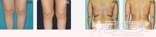 桂林美莱做吸脂手术案例