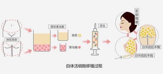 天津联合丽格自体脂肪颗粒注射移植术