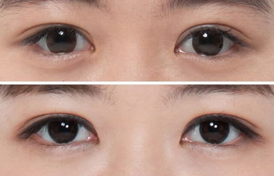 北京爱悦丽格医疗美容双眼皮修复