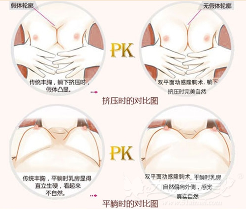 昆山百达丽双平面动感丰胸PK传统假体隆胸