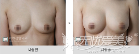 韩国麦恩整形医院自体脂隆胸术案例