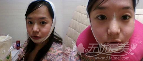李念在韩国原辰整形外科做面部轮廓术后1周
