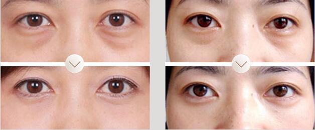 北京加减美医疗美容整形祛眼袋手术