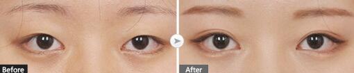 大理金格整形双眼皮手术对比案例图