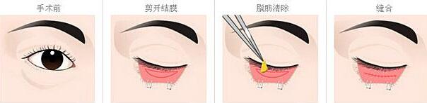 北京亚馨美莱坞去除眼袋手术