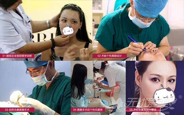 广州广美自然无痕双眼皮手术过程