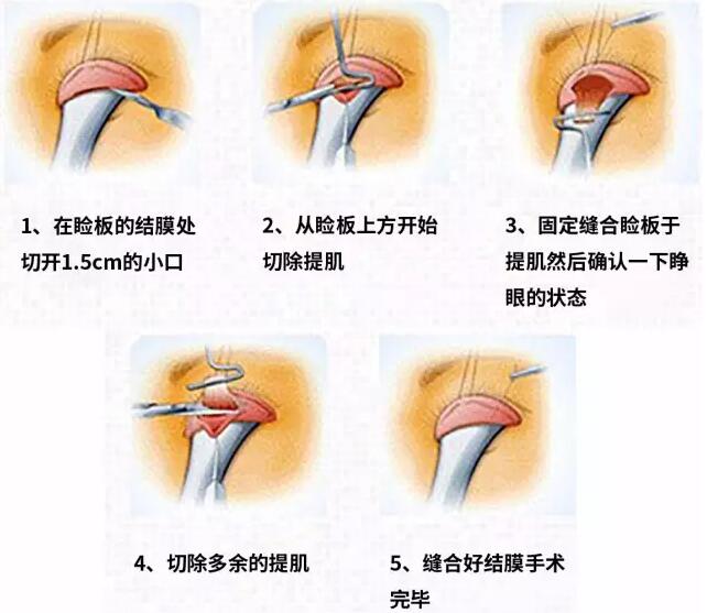 广州艺美医疗美容整形医院综合美眼