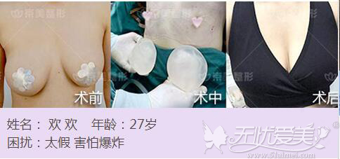 北京京美取假体脂肪隆胸前后对比案例