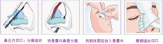 北京奥德丽格假体隆手术过程