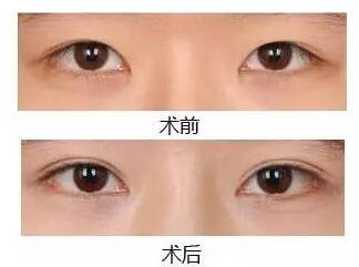 上海九院整形科眼部整形价格一览表+眼部整形案例