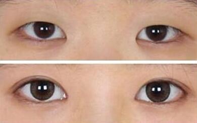 宁波江北韩美整形韩式双眼皮对比案例