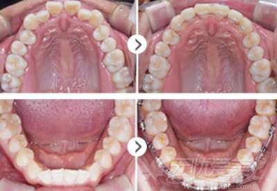 韩国优露牙科牙齿矫正案例