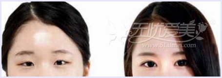 巴中双均整形20-28岁双眼皮手术