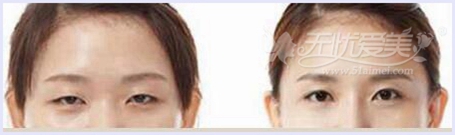 巴中双均整形28-38双眼皮手术