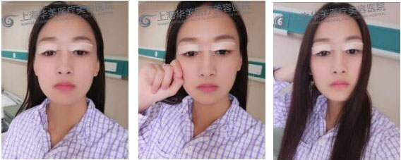 上海华美双眼手术后一天