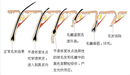 深圳京南门诊部激光脱毛