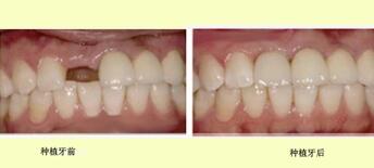 桂林美奥口腔All-on-4种植牙技术效果对比案例