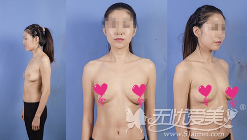 方芷沅在上海华美做隆胸手术前