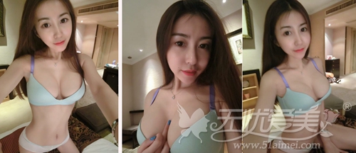 方芷沅在上海华美做隆胸术后5个月