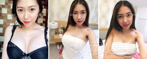 方芷沅在上海华美做隆胸术后7个月