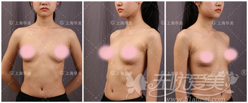 上海华美顾客刘若薇隆胸手术案例