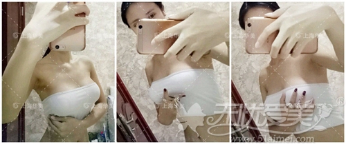 上海华美顾客刘若薇隆胸术后50天照片