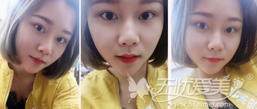 王菁菁在上海华美做双眼皮术后20天