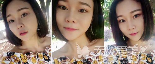 王菁菁在上海华美做双眼皮术后2个月