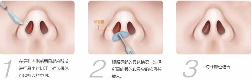 韩国JAYJUN假体隆鼻手术过程
