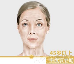 45岁以上衰老期