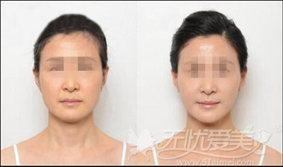 长沙半岛面部线雕提拉案例