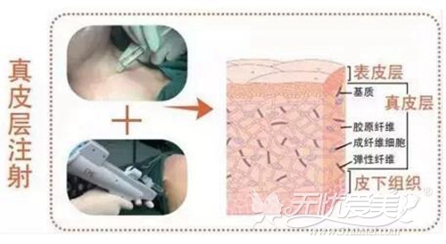 石家庄雅芳亚嗨体颈纹填充针的注射方法
