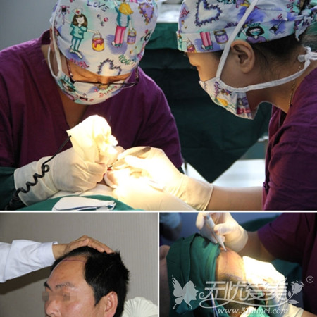 北京博士园MUT鲜活细胞植发技术手术过程