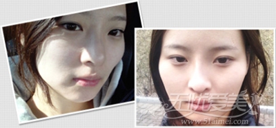 郑心妍在韩国TL整形医院做面部轮廓+自体脂肪填充手术前