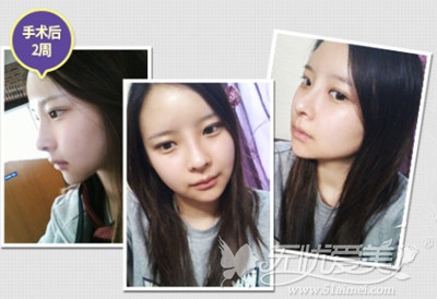 郑心妍在韩国TL整形医院做面部轮廓+自体脂肪填充术后2周