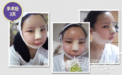 郑心妍在韩国TL整形医院做面部轮廓+自体脂肪填充术后3天