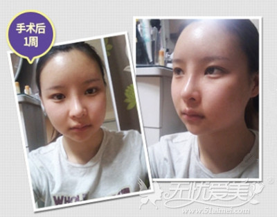 郑心妍在韩国TL整形医院做面部轮廓+自体脂肪填充术后1周