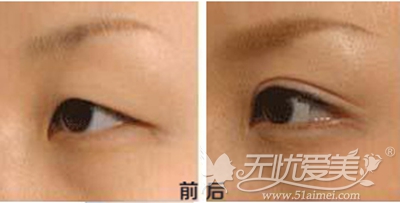 重庆铜雀台韩式双眼皮手术