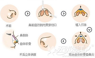 重庆联合丽格鼻综合手术过程