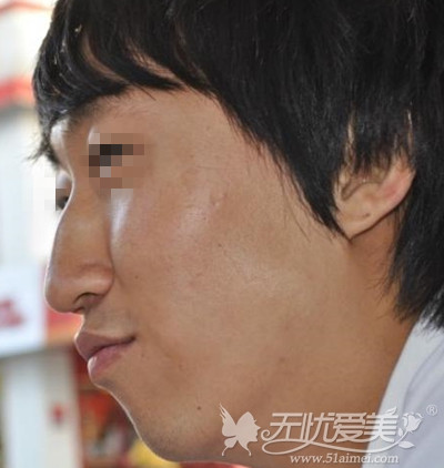 我在郑州欧兰驼峰鼻矫正手术前照片