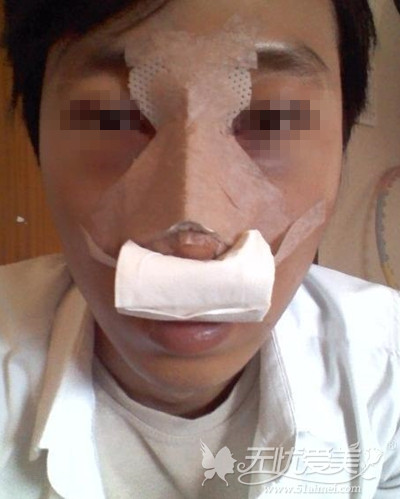 我在郑州欧兰驼峰鼻矫正手术当天
