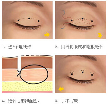武汉大学人民医院埋线双眼皮手术