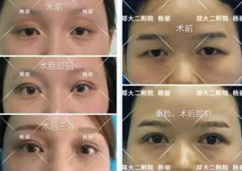 郑大第二附属医院美容科双眼皮修复案例