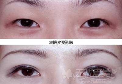 烟台美神韩式双眼皮手术案例